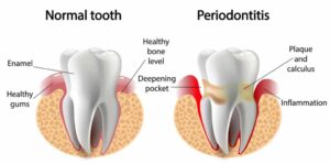 بیماری لثه و ایمپلنت دندان