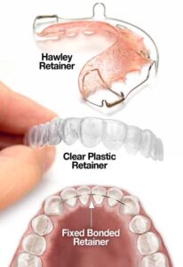 انواع ریتینرهای دندان