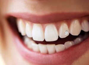 تتو دندان چیست