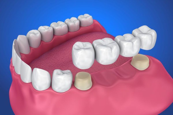 عمر روکش های دندان و بریج دندان چقدر است؟ – کلینیک دندانپزشکی اوستا