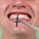 چرا جای ایمپلنت دندان درد می گیرد