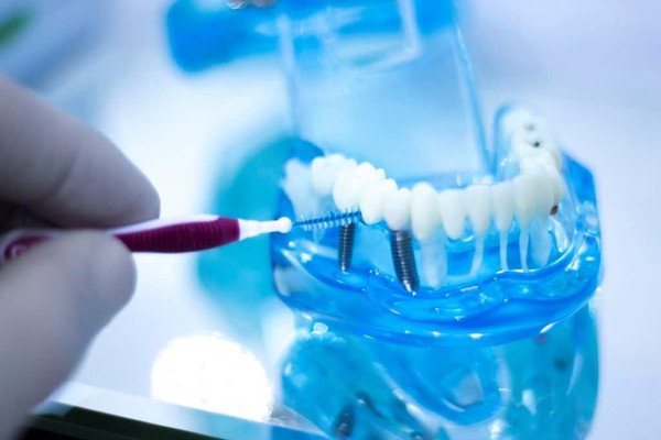 تمیز کردن ایمپلنت دندان