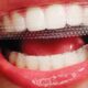 نوارهای سفیدکننده دندان