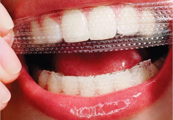 نوارهای سفیدکننده دندان