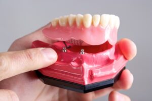 دندان مصنوعی Snap-In