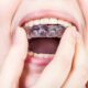 برای دندان قروچه چه محافظ دهانی خوبه؟