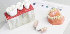 چطور از رشد باکتری ها بروی دندان مصنوعی جلوگیری کنیم؟