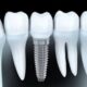 دنچر و ایمپلنت های دندان