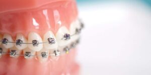 تفاوت بین دندانپزشک و ارتودنتیست چیست؟
