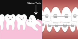 دندان های عقل چه تاثیری روی ارتودنسی دندان دارند؟!