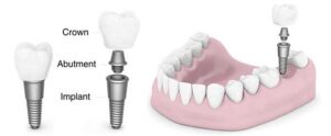 مزایای ایمپلنت تک دندانی چیست؟!