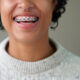 دندان های عقل چه تاثیری روی ارتودنسی دندان دارند؟!