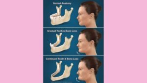 اهمیت ایمپلنت های دندانی روی ساختار صورت