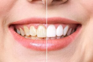 آیا به دنبال دندان های سفیدتری هستید؟