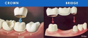 تاج و بریج دندان چیست؟