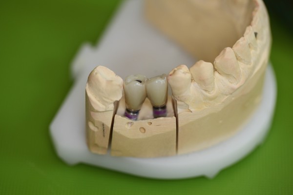 ایمپلنت دنچر چه فرقی با ایمپلنت بریج دارد؟